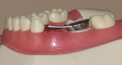 Sâu răng hàm ở trẻ em không đơn giản.
