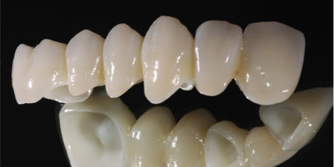 Răng toàn sứ Cercon-Zirconia