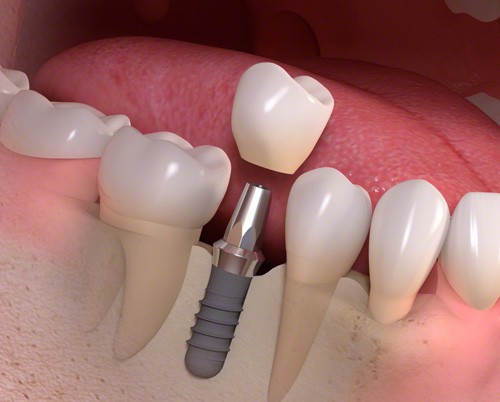 Trồng răng implant có đau có nguy hiểm không ?