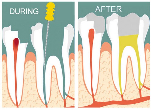 Những trường hợp nào cần trám răng lấy tuỷ