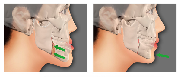 Với trường hợp bệnh nhân bị vẩu hàm dưới (móm), bác sĩ sẽ thực hiện phẫu thuật chỉnh hàm vẩu bằng kỹ thuật BSSO.