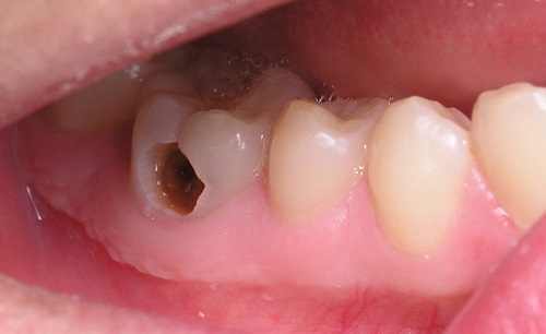 Hàn răng cho trẻ giúp hạn chế sâu răng