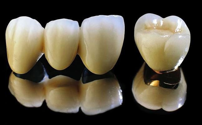 Tìm hiểu về răng sứ Titan