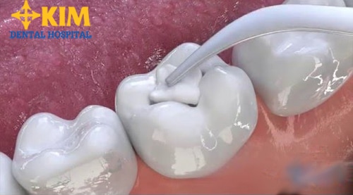 Trám răng có đau không có an toàn không ?