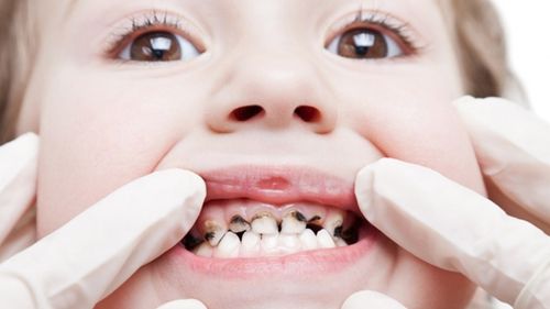 Phụ huynh sẽ được tư vấn về quá trình thay răng của trẻ khi tiến hành nhổ răng trẻ em miễn phí