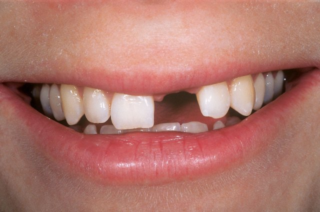 Ai phù hợp để cấy răng Implant ?