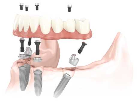 Trồng răng all on 4 bằng cấy ghép Implant