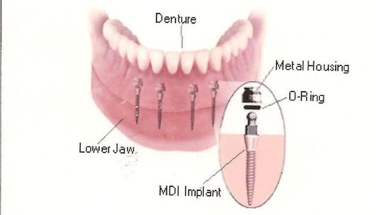  Cấy ghép mini Implant là gì ?