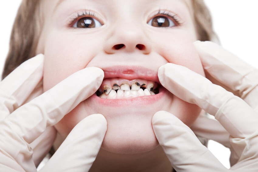 Sâu răng sữa ở trẻ em là điều thường gặp 