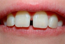 Răng cửa bị thưa có thể do bẩm sinh hoặc do bệnh lý răng miệng