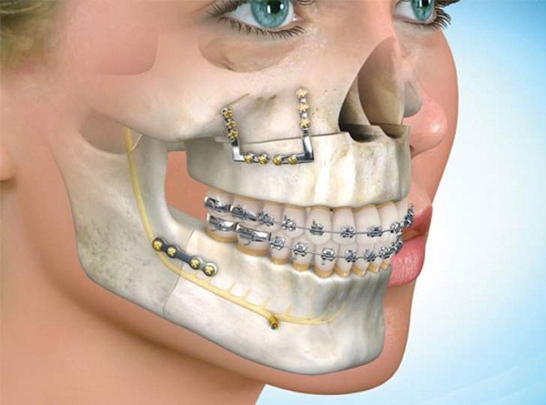 Đối với những bệnh nhân bị hô cả hai hàm, bác sĩ sẽ tiến hành chỉnh hàm vẫu bằng cách cắt xương tiền đình của cả hàm trên và hàm dưới.